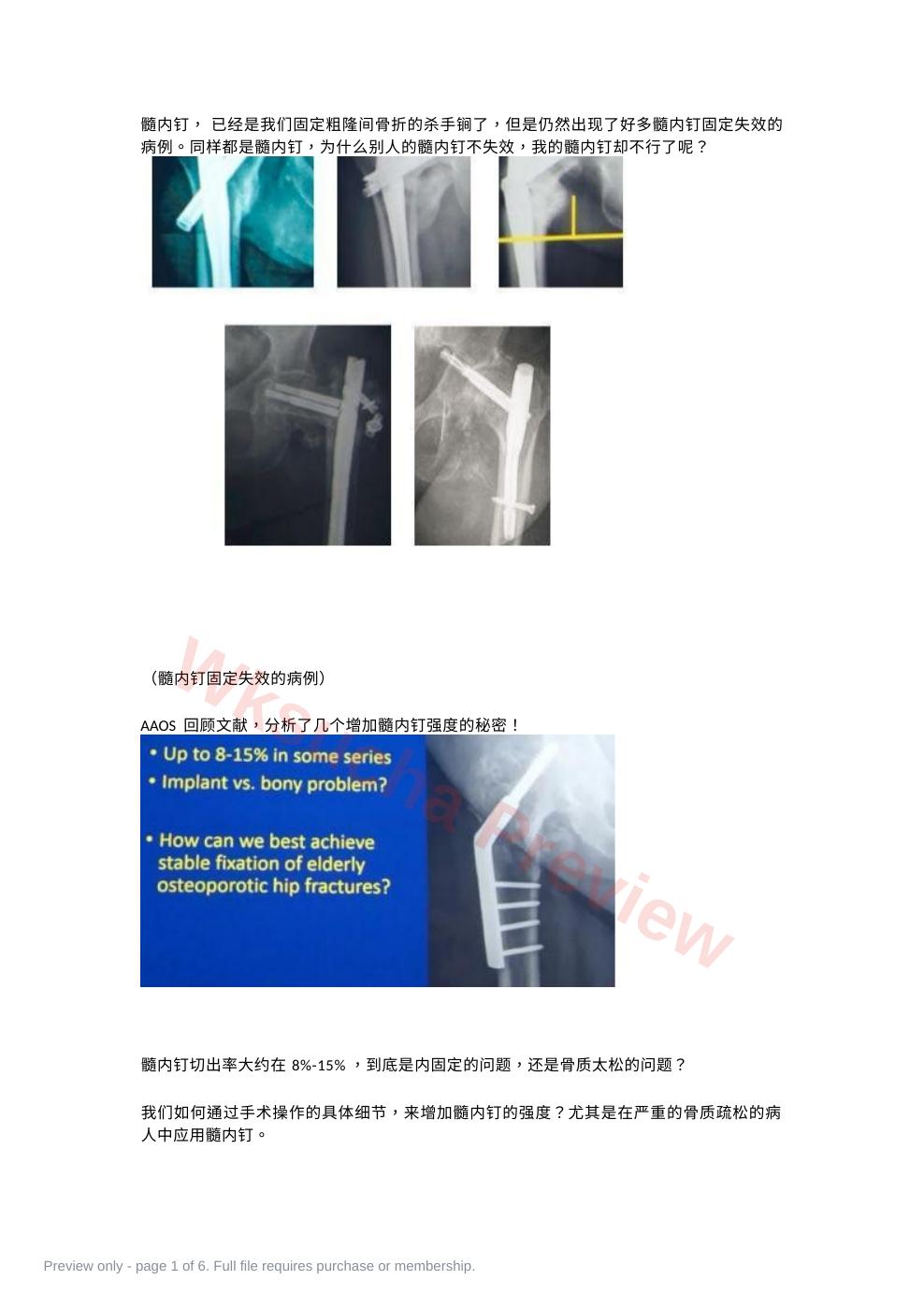 如何提高髓内钉的内固定强度