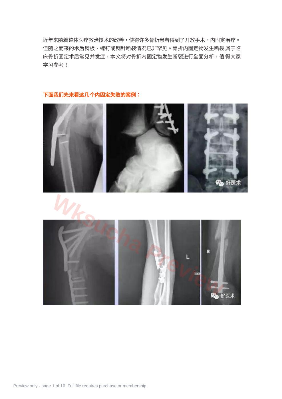 骨科内固定物断裂原因分析