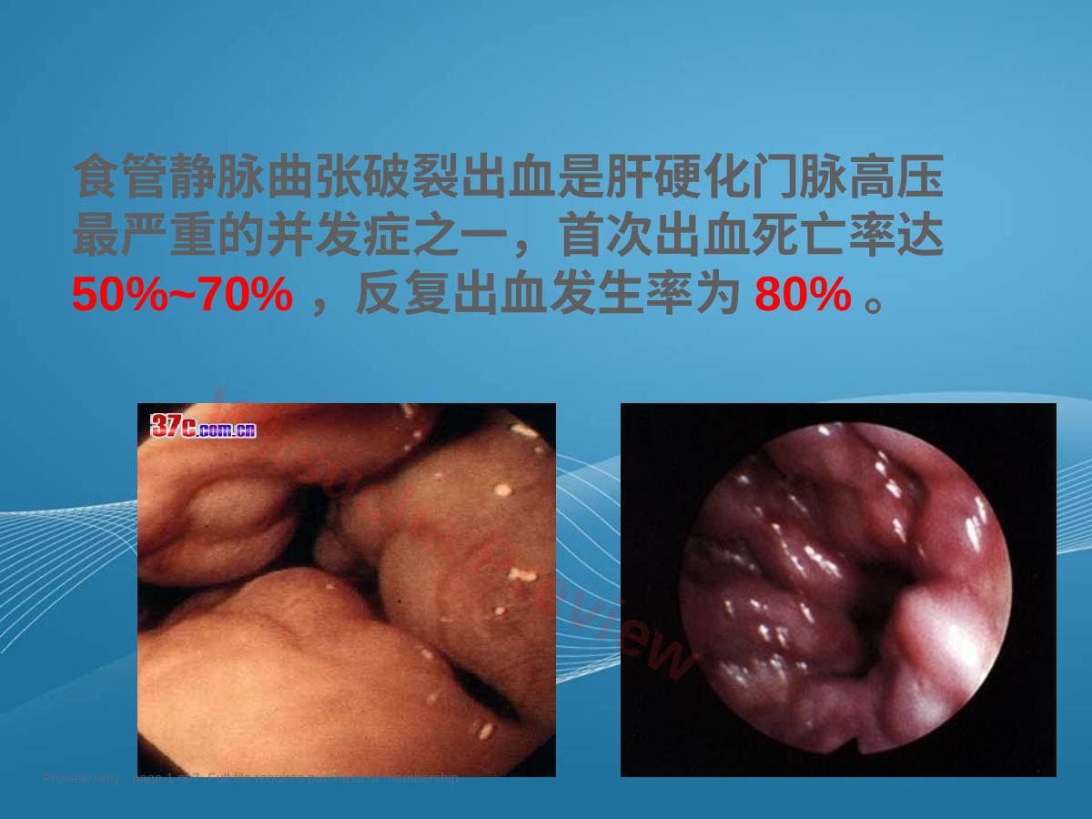 套扎术在肝硬化患者中的应用和护理PPT