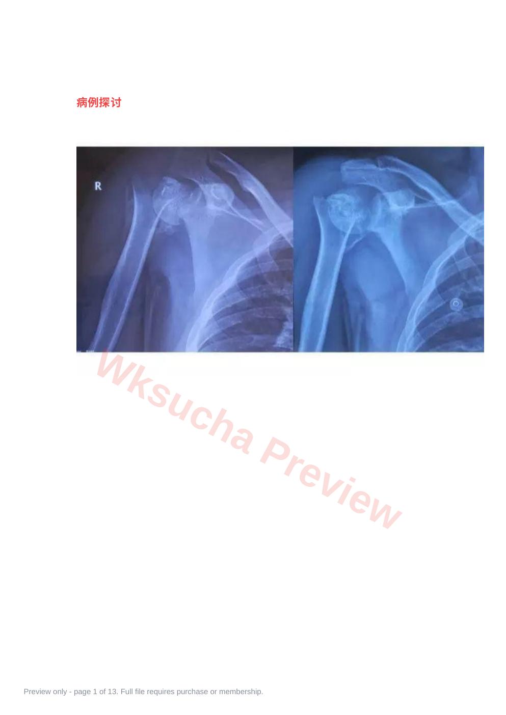 肩关节反向假体置换术 技巧