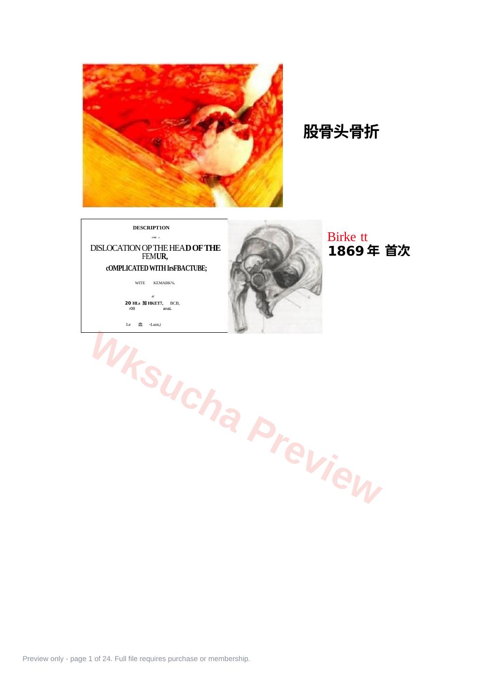 股骨头骨折的手术入路及方法