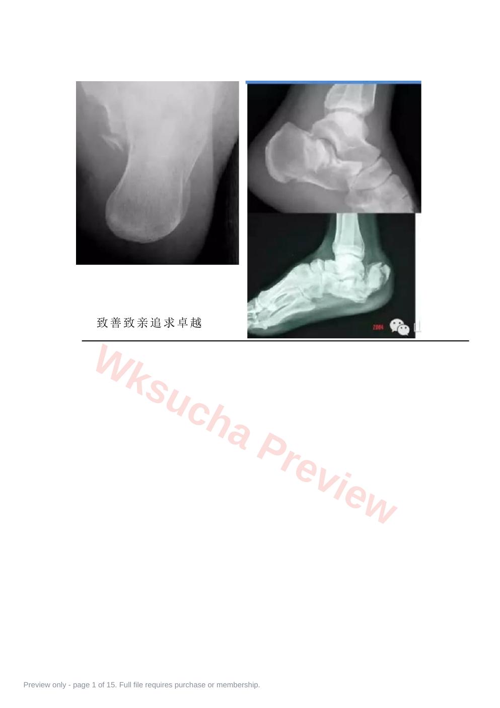 跟骨骨折的分型详解