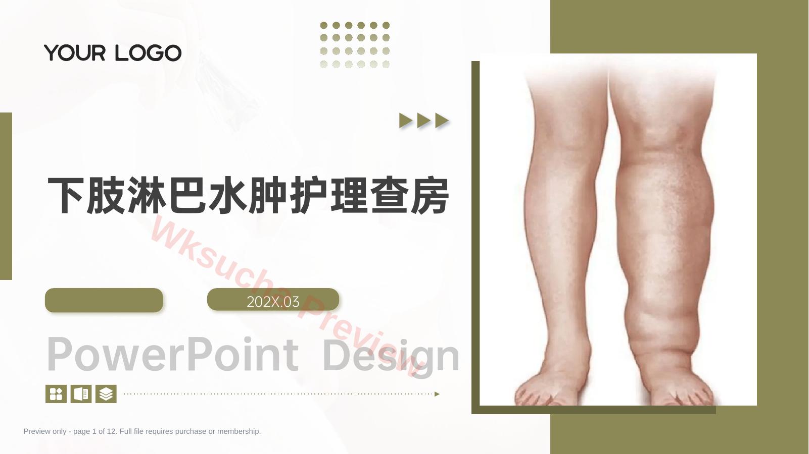 下肢淋巴水肿护理查房带参考文献